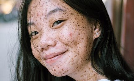 Eliminate Your Pimples Using These Basic Steps