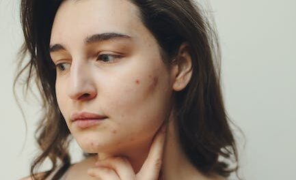 Pimples Totally free Suggestions To Help Keep Your Pores and skin Stunning
