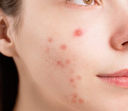 Difficulties With Pimples? Take A Look At These Helpful Ideas!